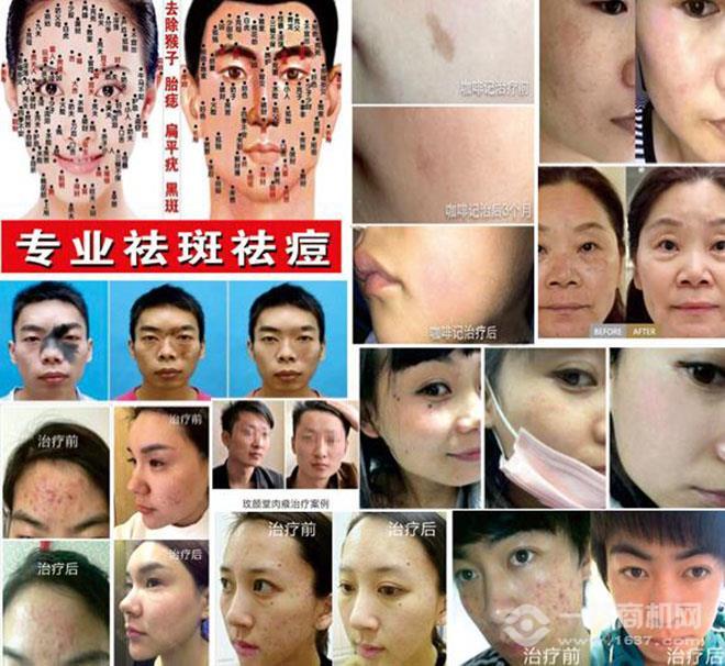 玫颜堂祛斑祛痘