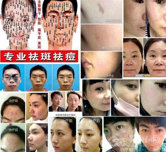 玫颜堂祛斑祛痘