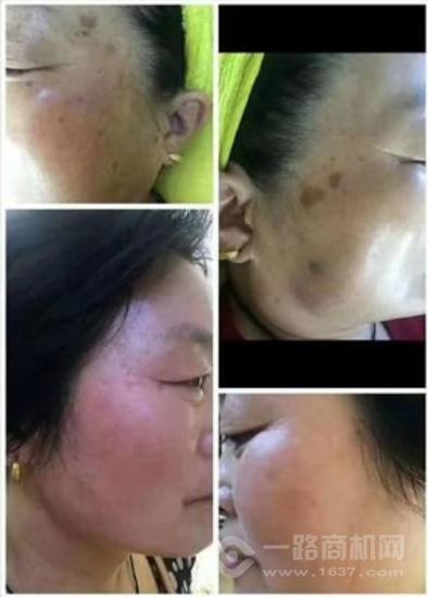 琳钰颜祛斑加盟 琳钰颜祛斑加盟