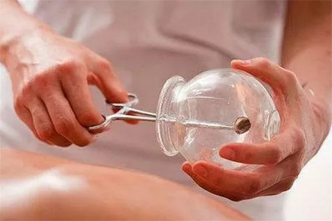 拔罐减肥 拔罐减肥