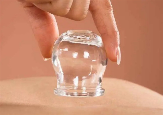 拔罐减肥 拔罐减肥