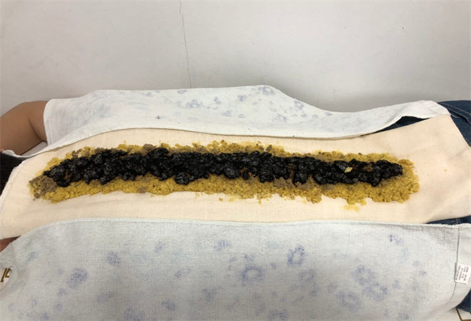 千年囯医扶阳艾灸