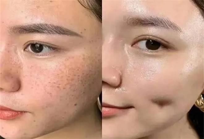 尊瑞专业祛斑祛痘