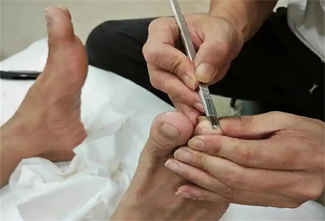 山西修脚 山西修脚